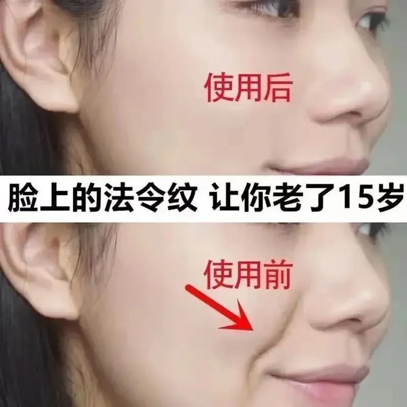 1PC V Face Lifting Tool Removal of Nasolabial Folds To Eliminate Artifact Facial Tightening Face Sagging Face-lifting Instrument